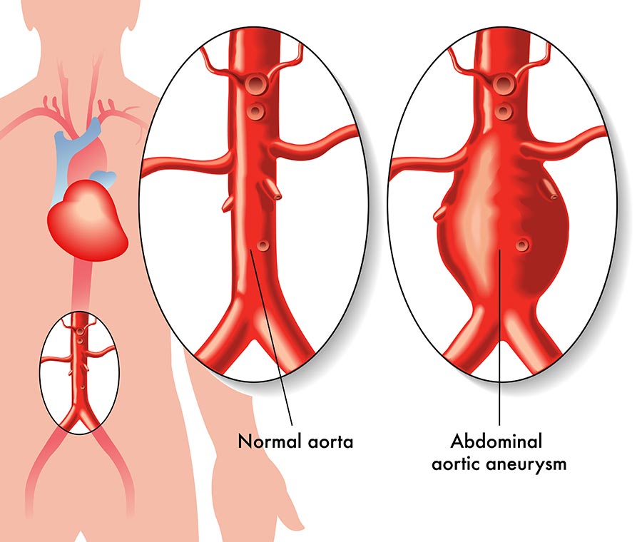 Abdominal Aortic Aneurysm