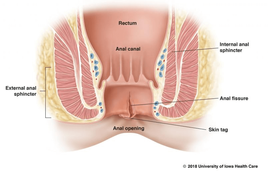 Anal fissure ការរហែករន្ធគូថ