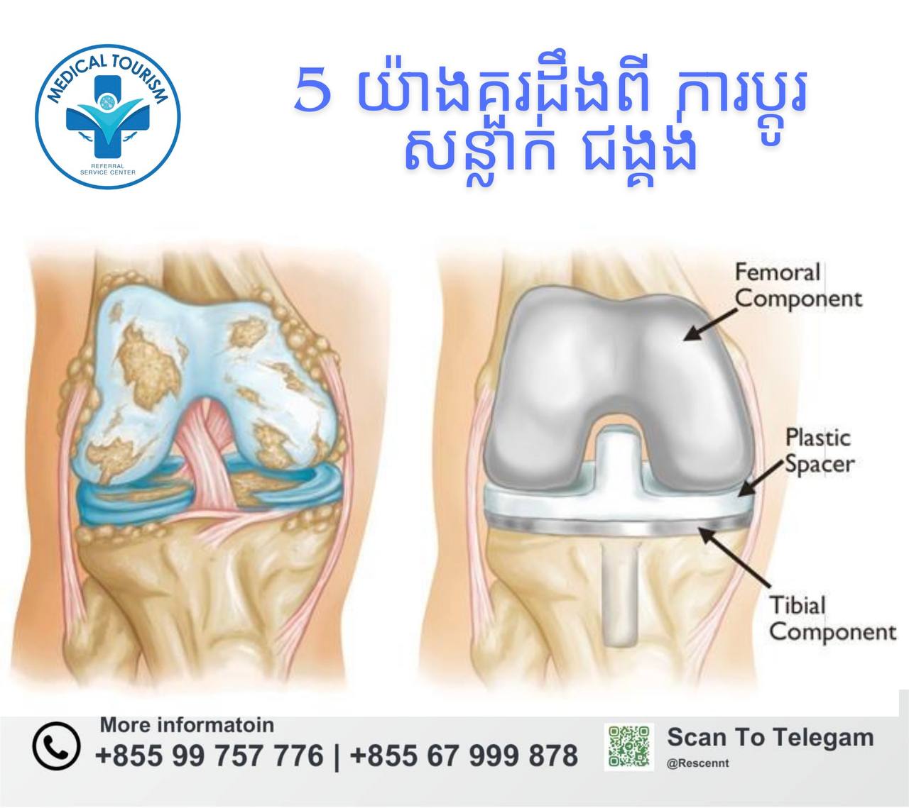 ប្តូរសន្លាក់ជង្គង់