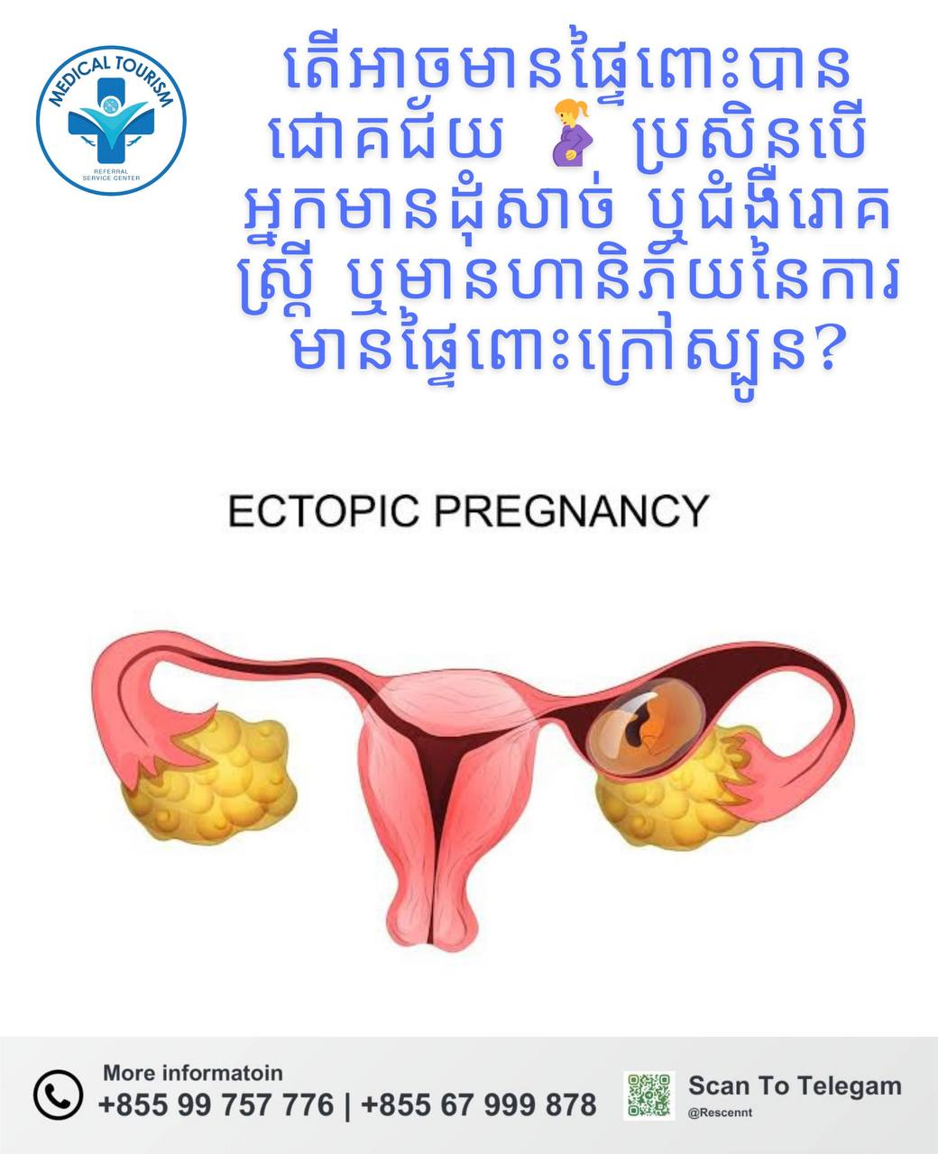 កាេមានផ្ទៃពះក្រៅស្បូន