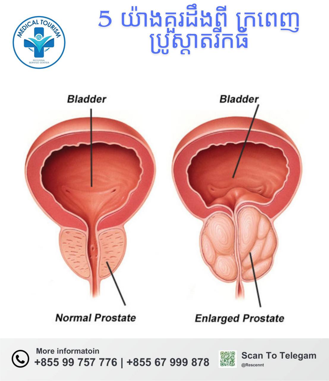 ក្រពេញប្រ៉ូស្តាតរីក