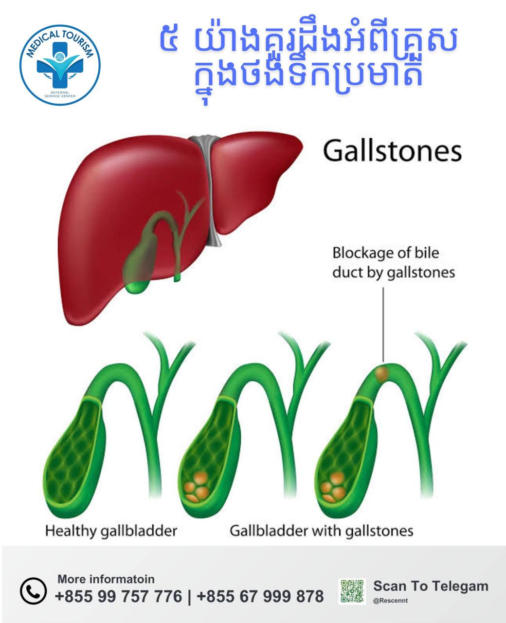 គ្រួសថង់ទឹកប្រមាត់