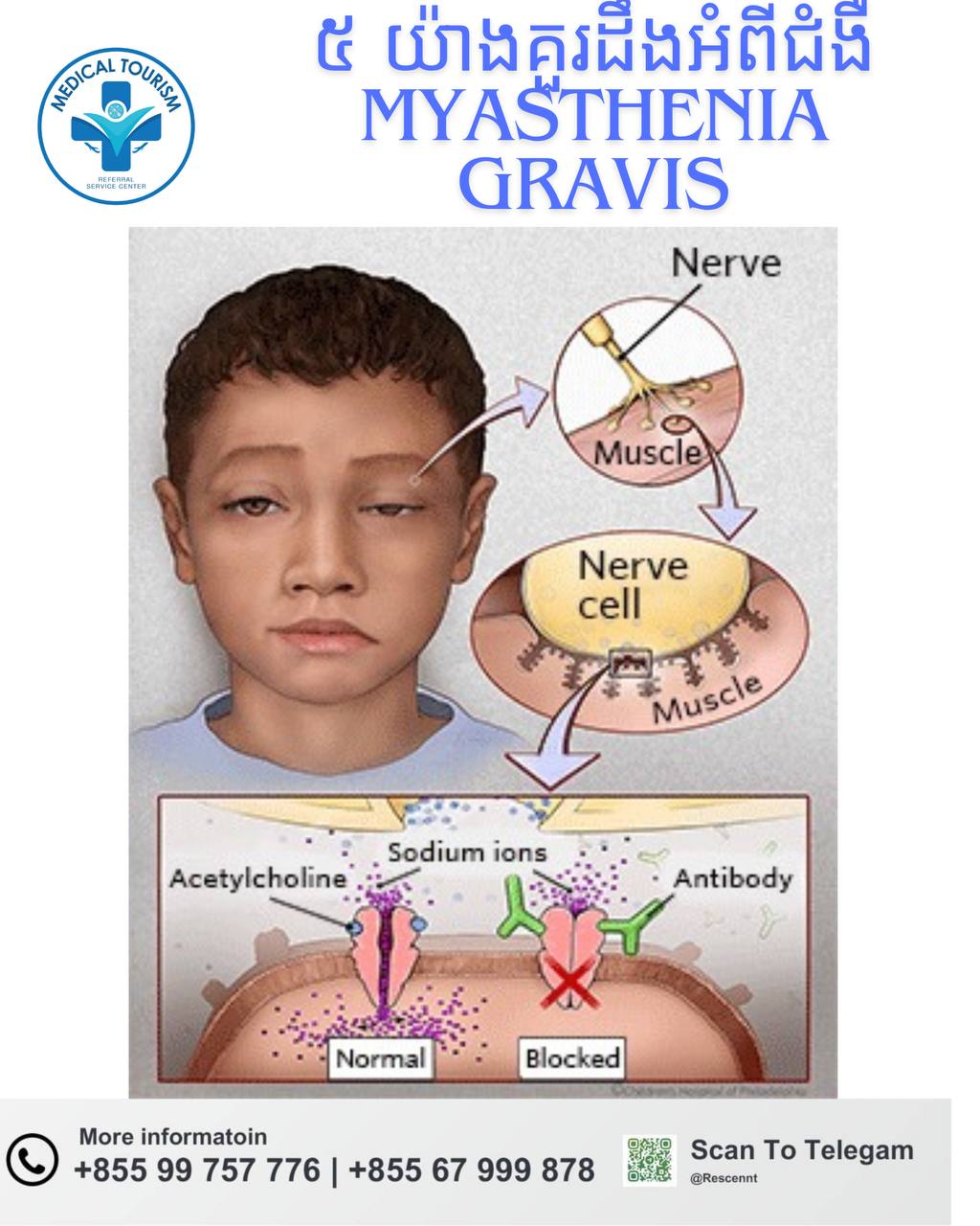 ជំងឺខ្សោយសាច់ដុំ