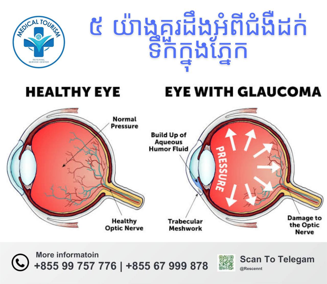 ជំងឺដក់ទឹកក្នុងភ្នែក