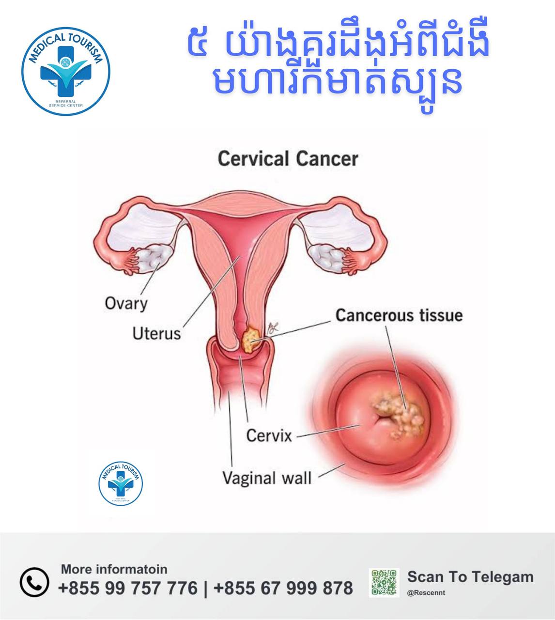 ជំងឺមហារីកមាត់ស្បូន