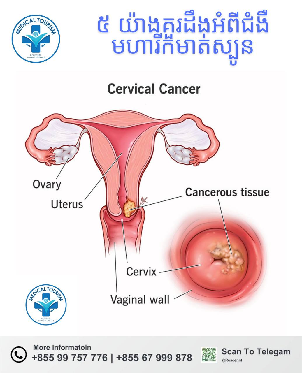 ជំងឺមហារីកមាត់ស្បូន