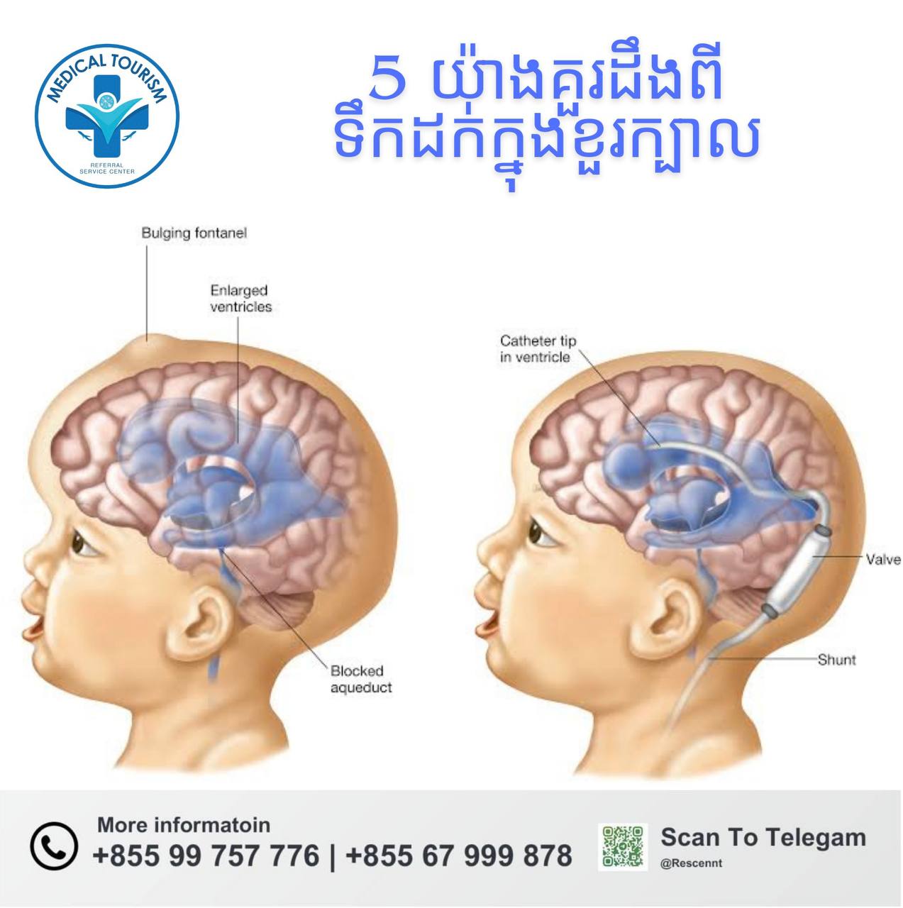 ទឹកដក់ខួរក្បាល