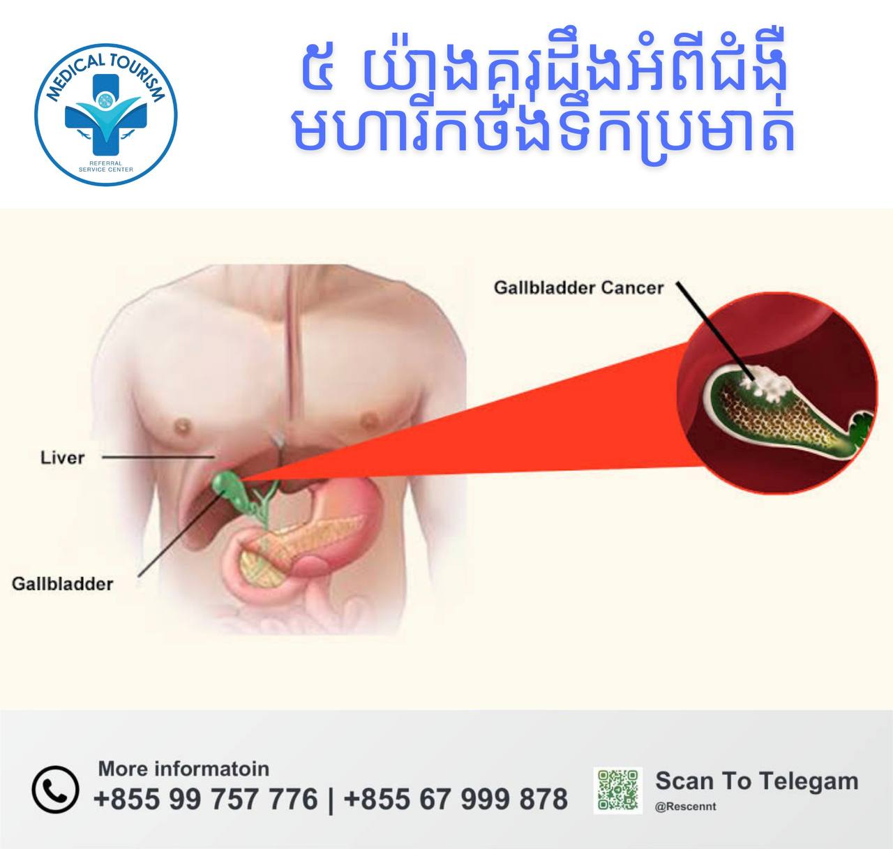 ជំងឺមហារីកថង់ទឹកប្រមាត់