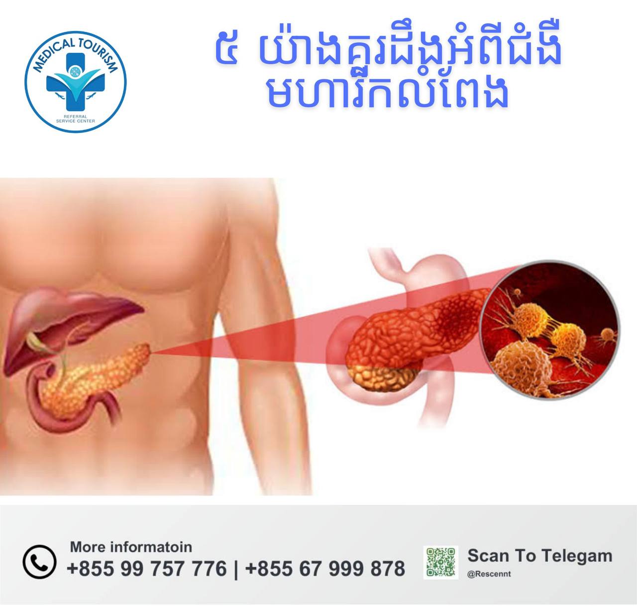 ជំងឺមហារីកលំពែង