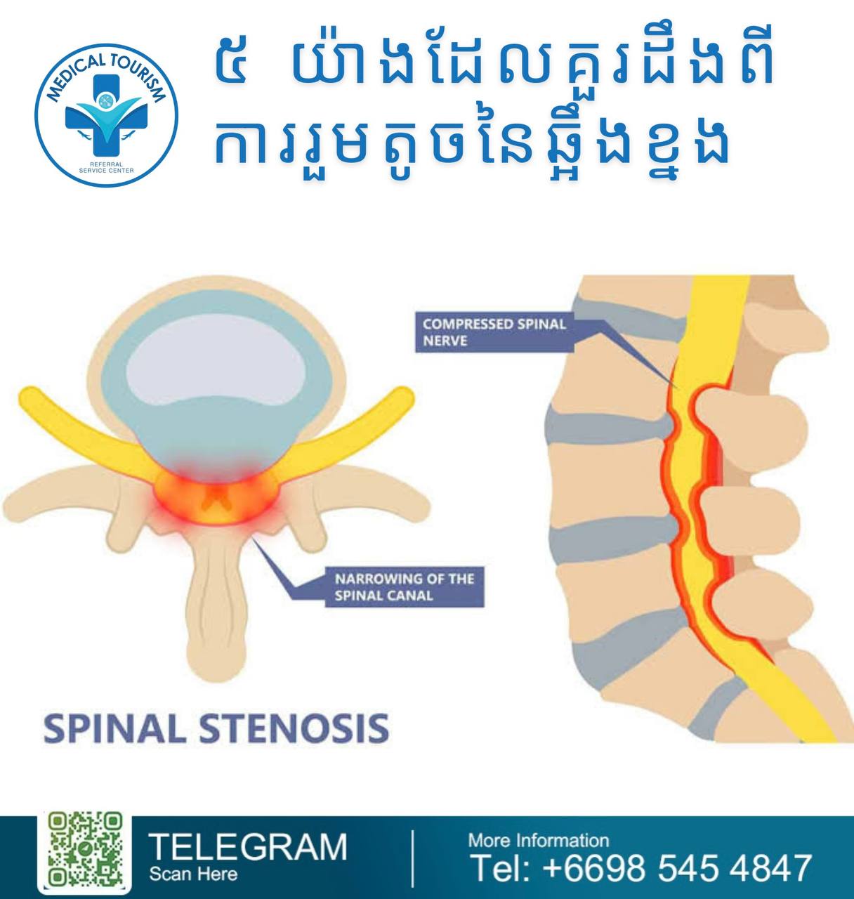 spinal stenosis