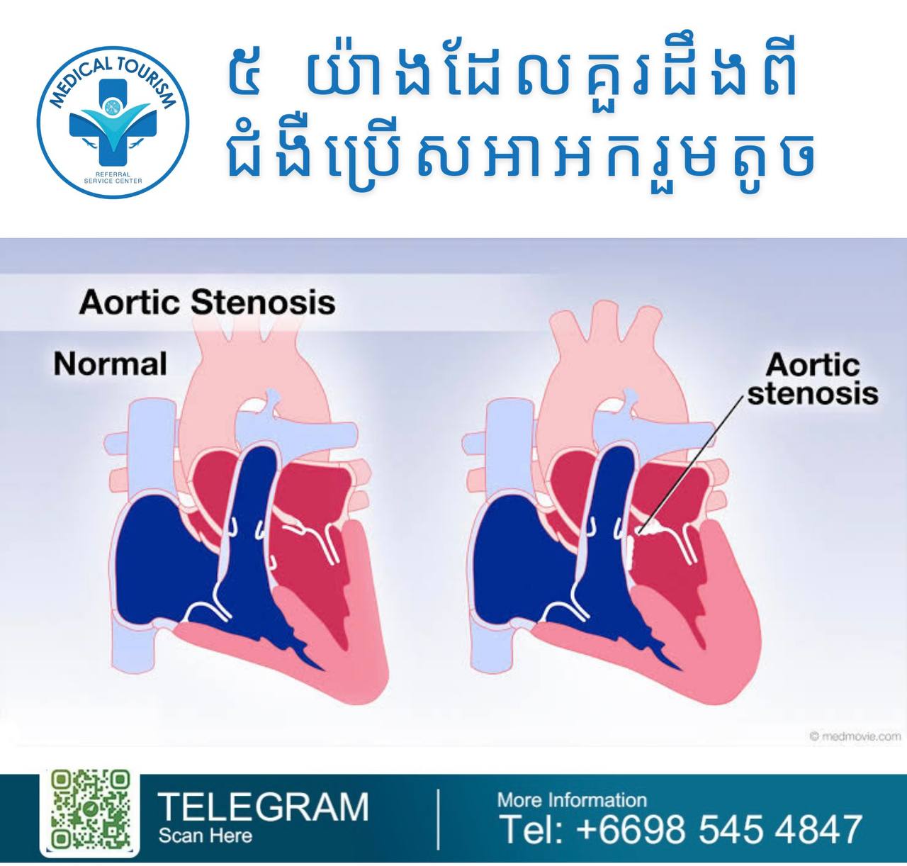 aortic stenosis