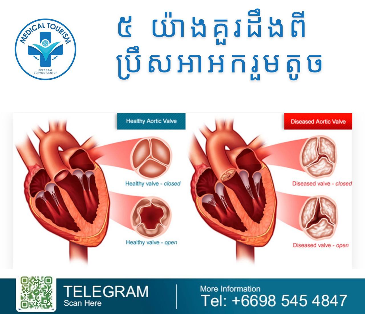 Aortic stenosis