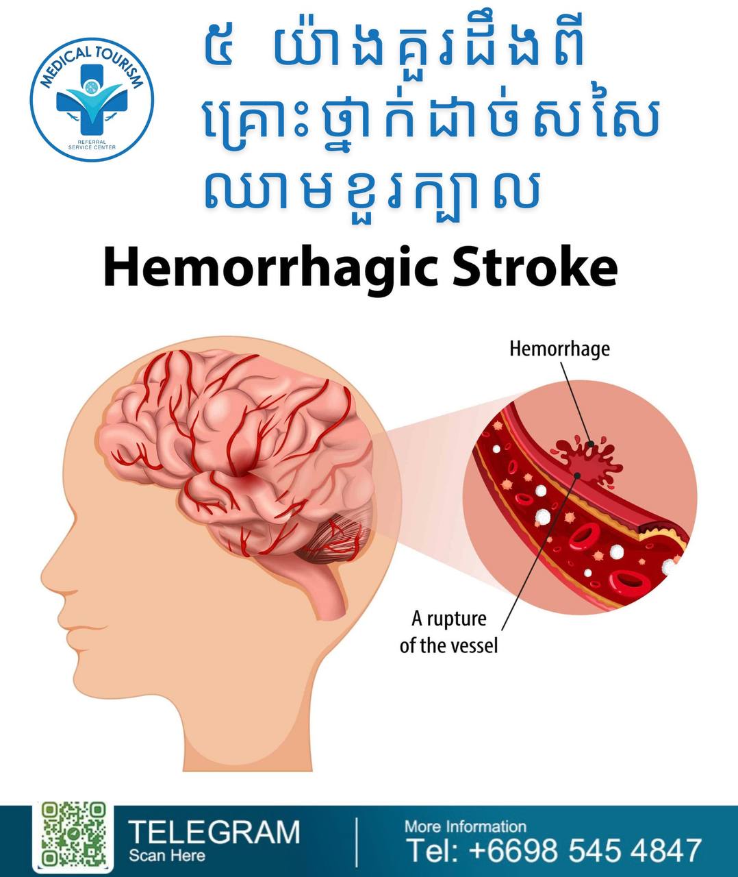 Hemorrhagic stroke