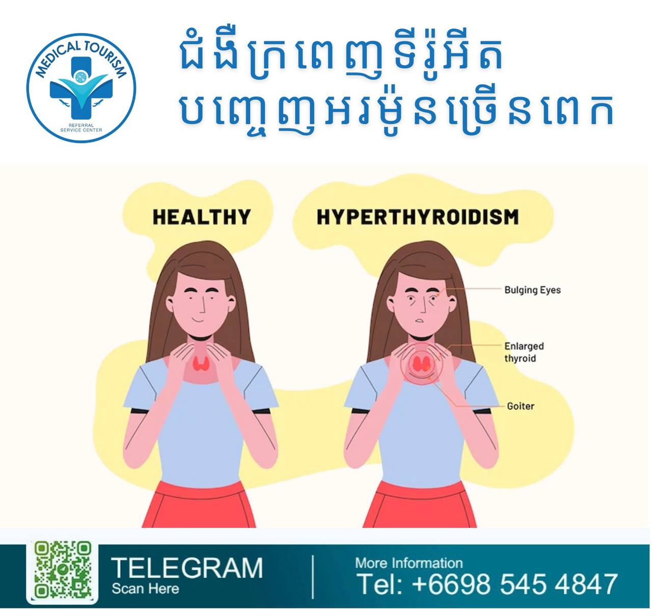 hyperthyroidism