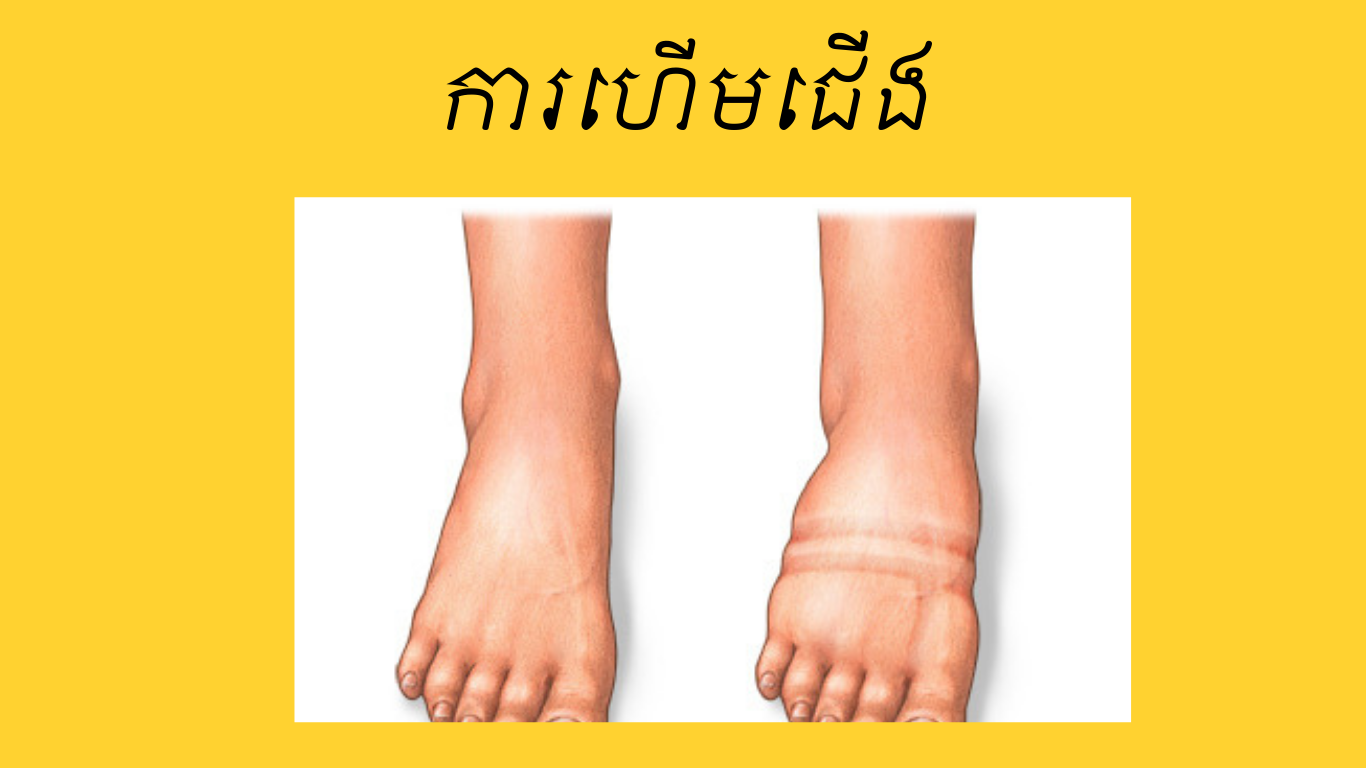 ហើមជើង