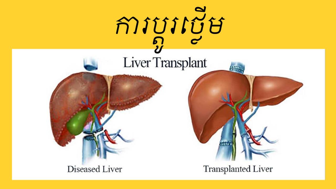 ការប្តូរថ្លើម