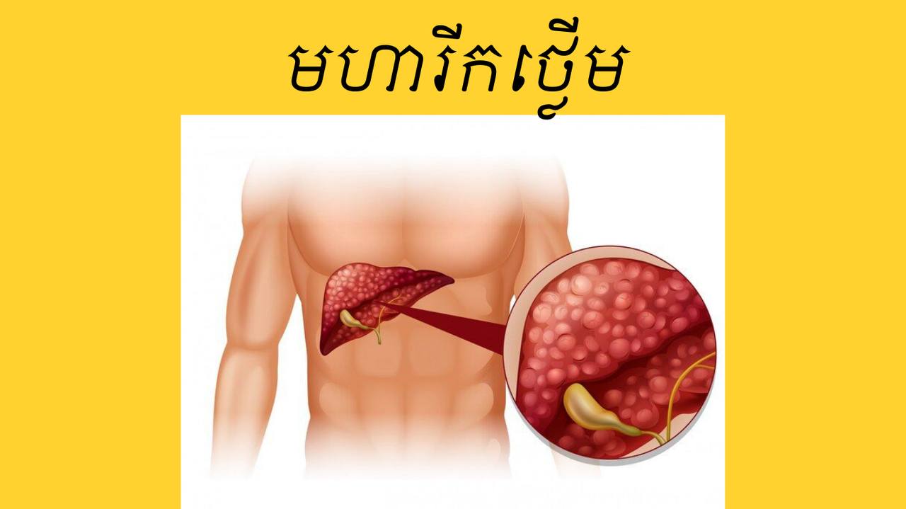 Liver cancer